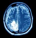 brain cancer misdiagnosis lawsuits 