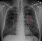 pulmonary embolism malpractice claims 